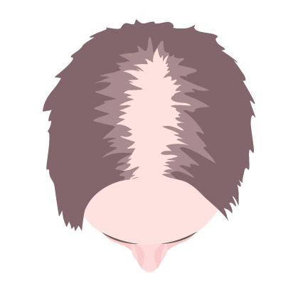 Female hair loss parting excessive