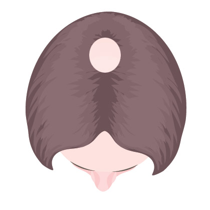 Female hair loss bald spot