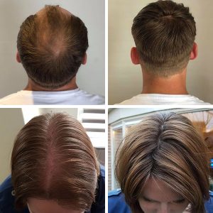 Hair solution for hair loss example - man and woman