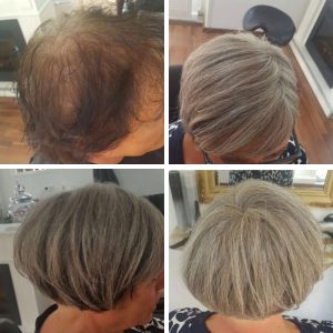 Hair loss solution - female before after
