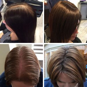 Hairpieces women, thinning hair before/after